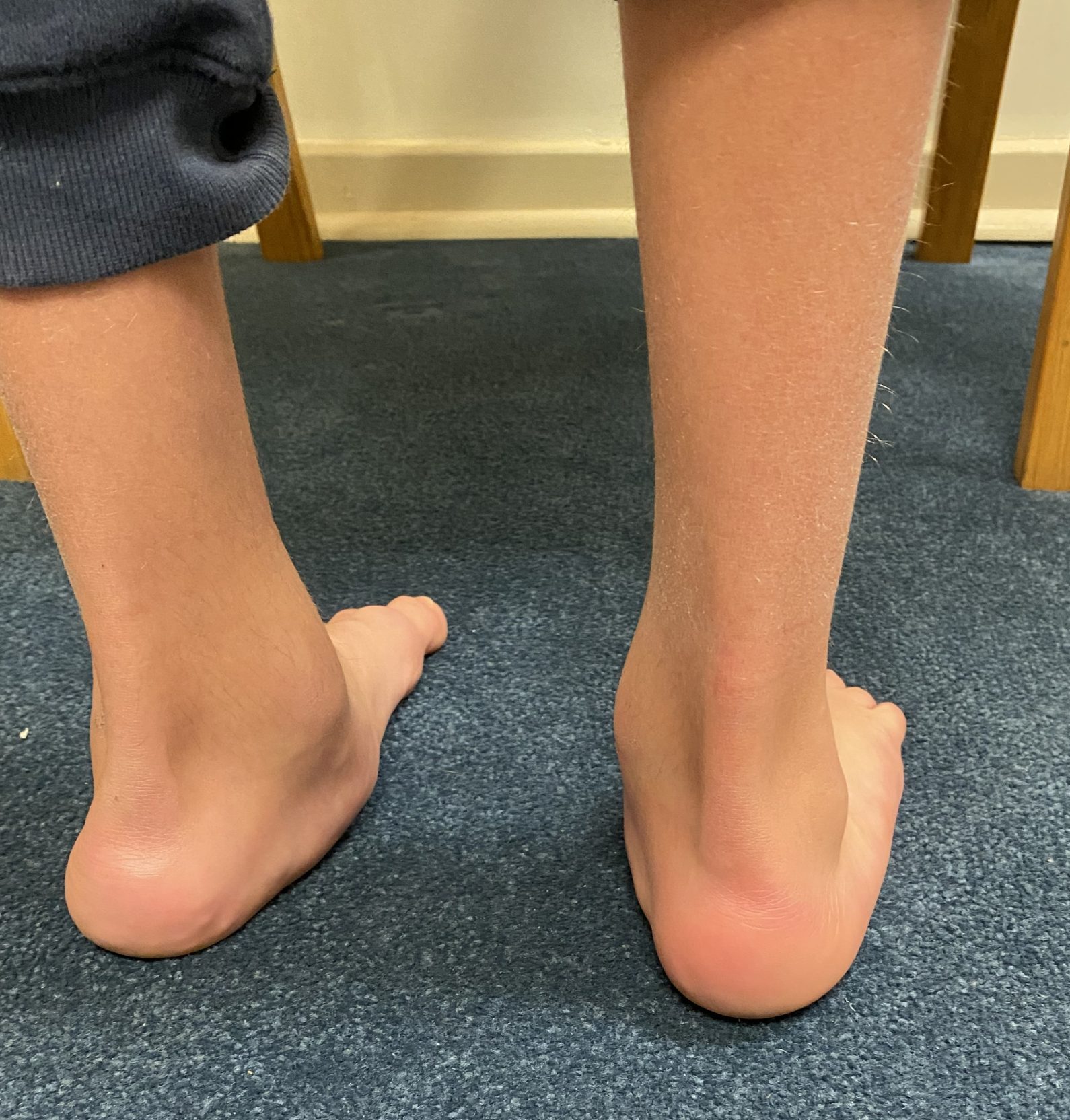 Congenital Flatfoot Hindfoot