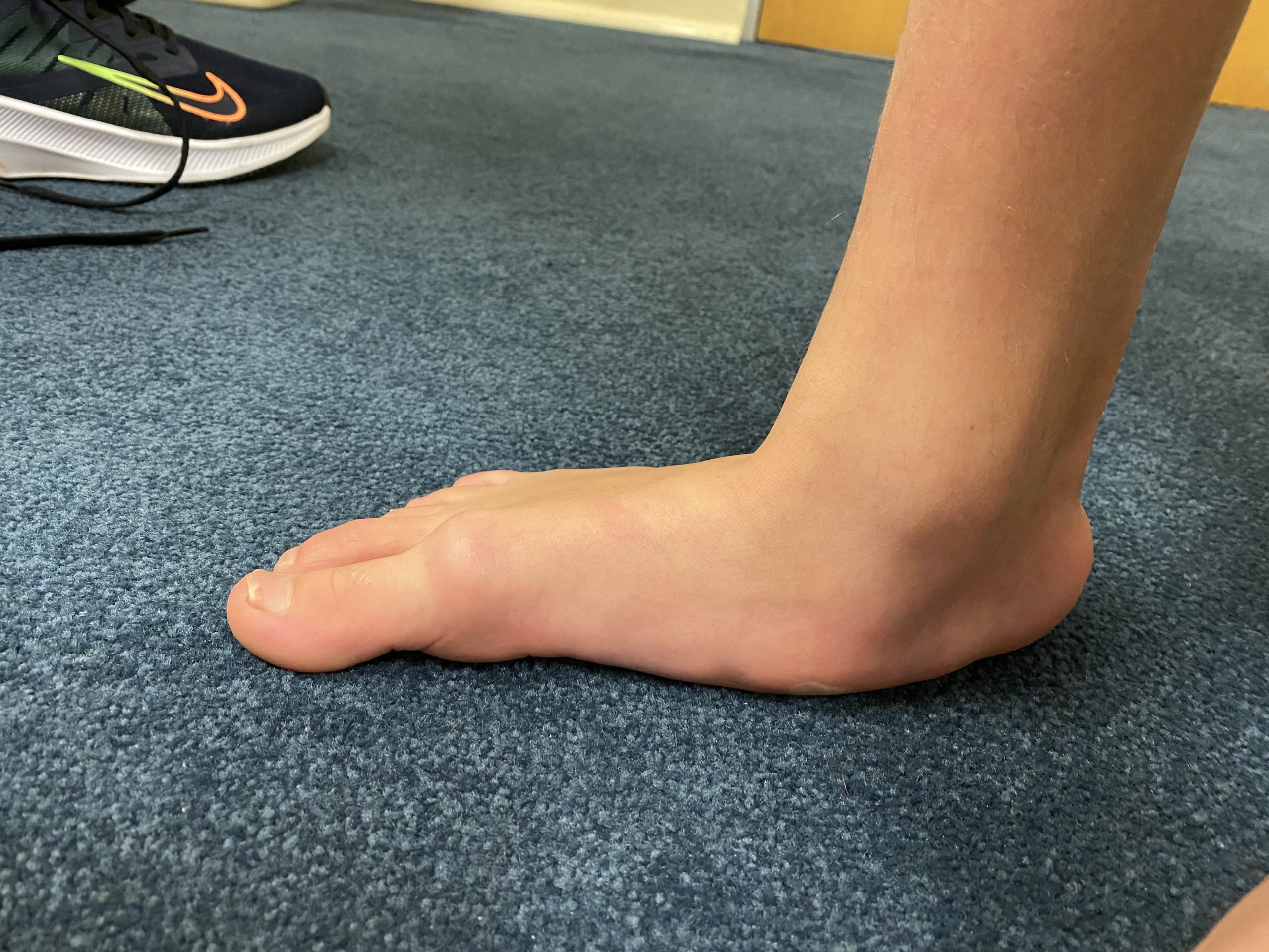 Congenital flatfoot