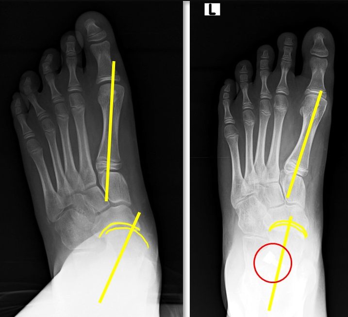 Flexible Flatfoot Arthroereisis Correct Pre- and Post- AP