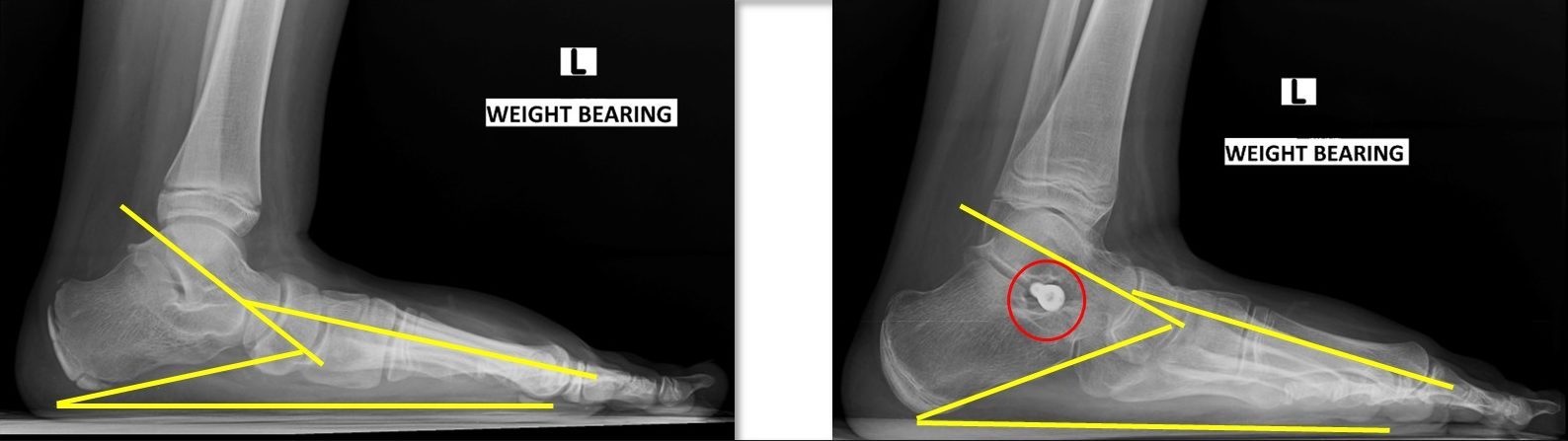Flexible Flatfoot Arthroereisis Correct Pre- and Post- Lat