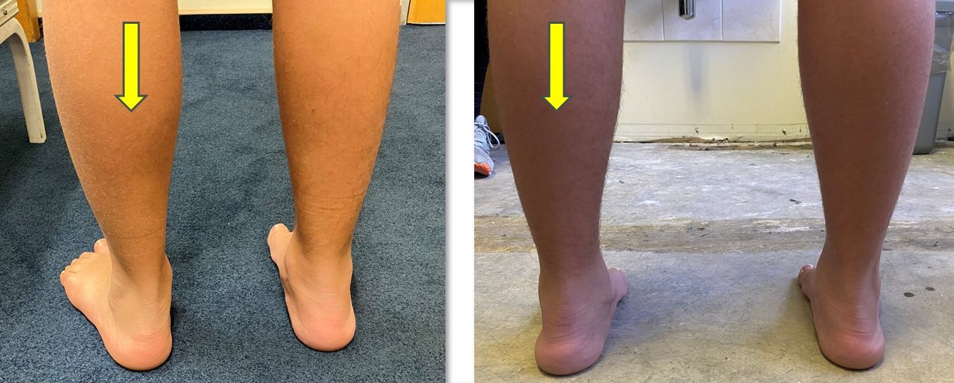 Flexible Flatfoot Arthroereisis Correct Pre- and Post- Clinical Back