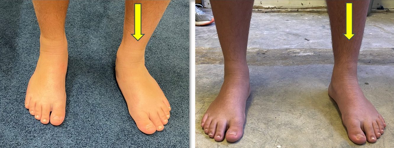 Flexible Flatfoot Arthroereisis Correct Pre- and Post- Clinical Front