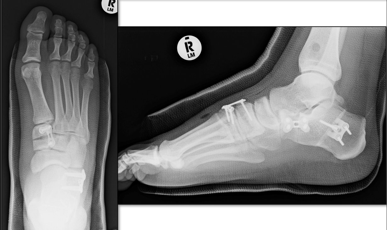 Flexible Flatfoot Post-Op X-Rays