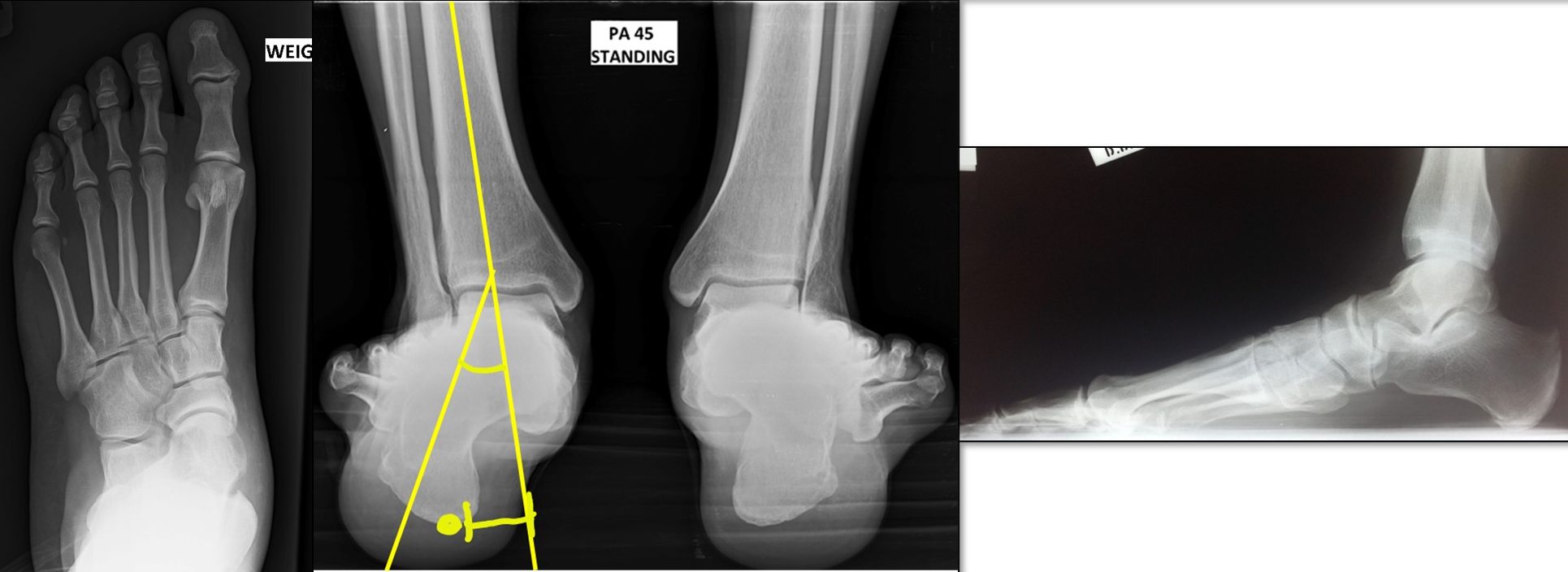 Flexible Flatfoot Pre-Op X-Rays