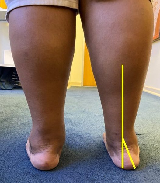 Hindfoot Valgus Clinical