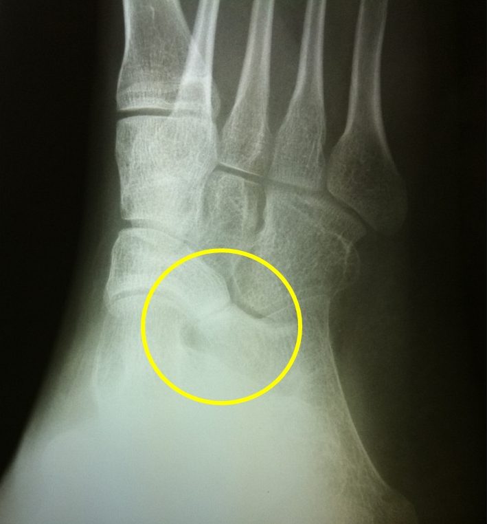 Rigid Flatfoot Calcaneo-Navicular Coalition