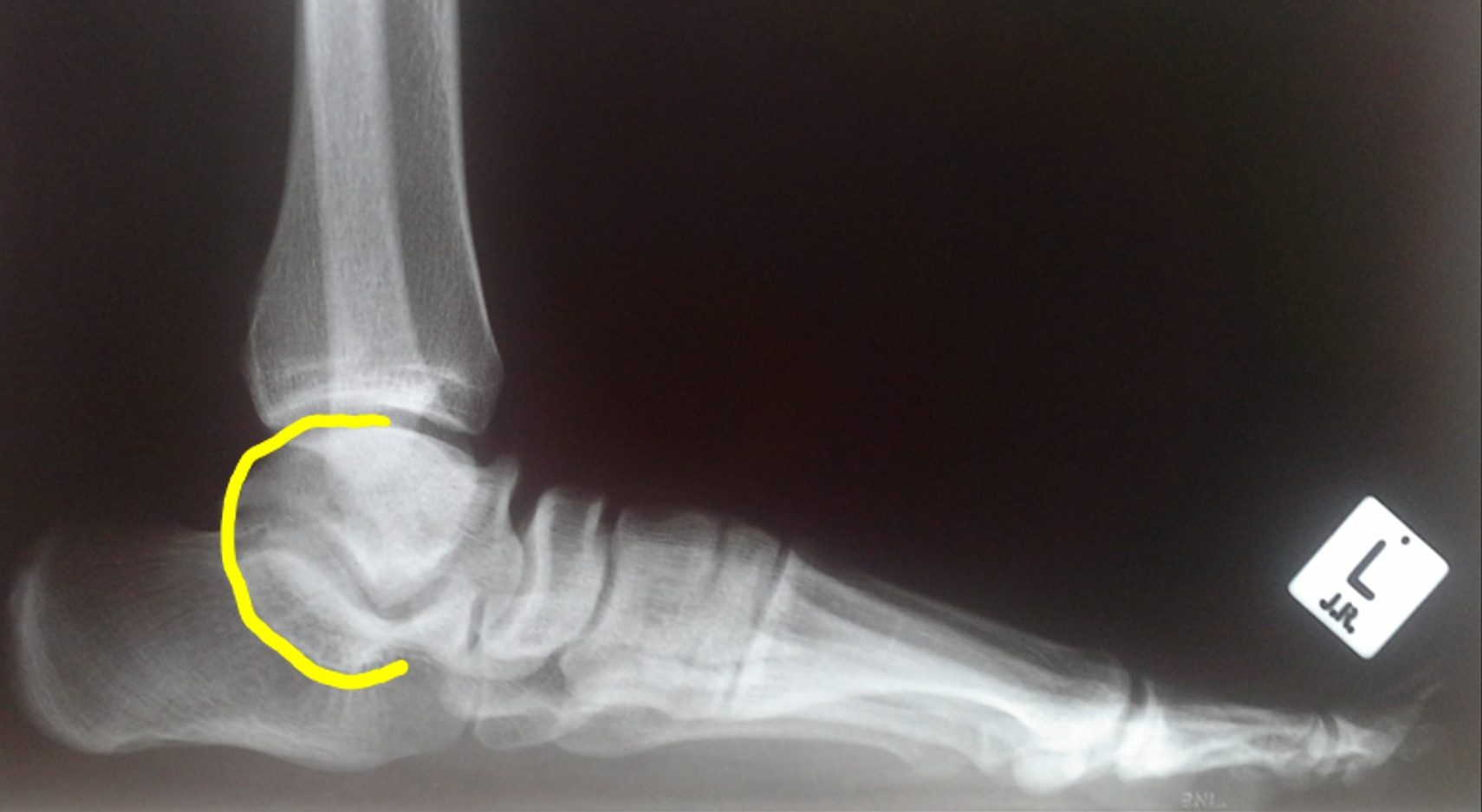 Rigid Flatfoot Talo-Calcaneal Coalition C-Sign X-Ray