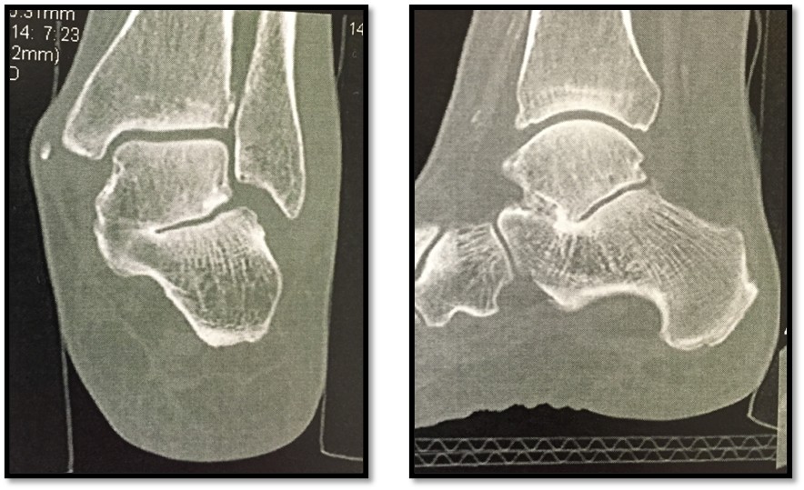 Rigid Flatfoot Talo-Calcaneal Coalition CT