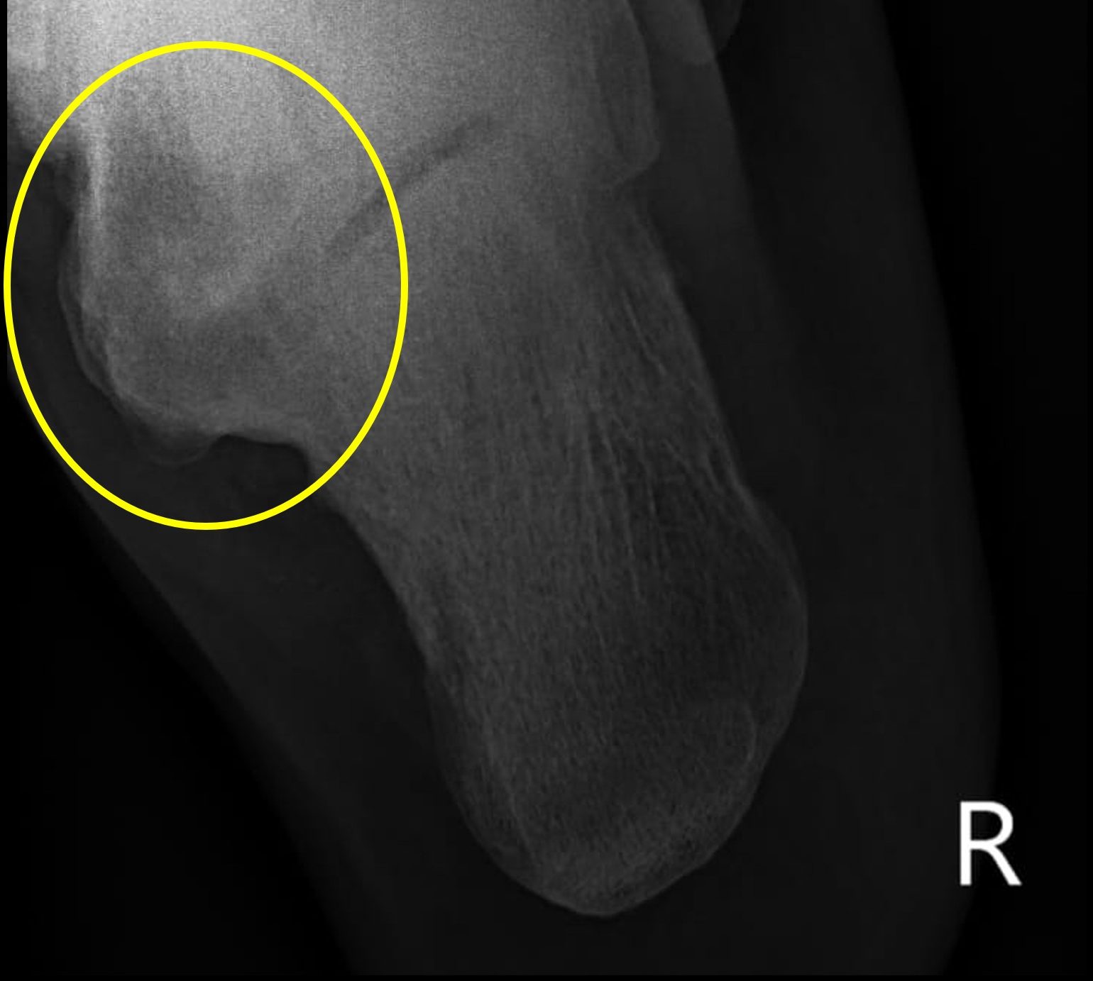 Rigid Flatfoot Talo-Calcaneal Coalition Harris Axial View X-Ray