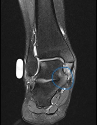 Rigid Flatfoot Talo-Calcaneal Coalition MRI