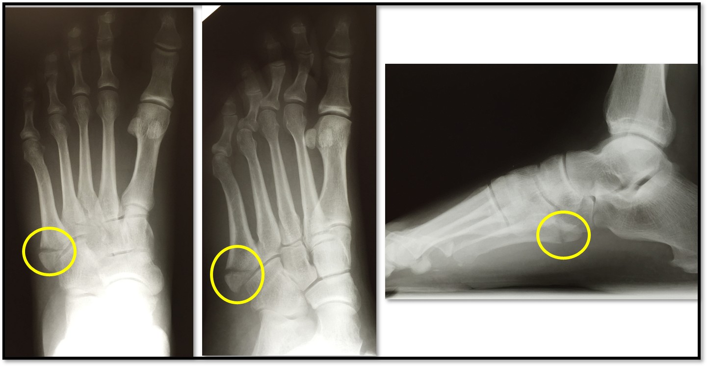 Zone 1 Avulsion fracture x-rays