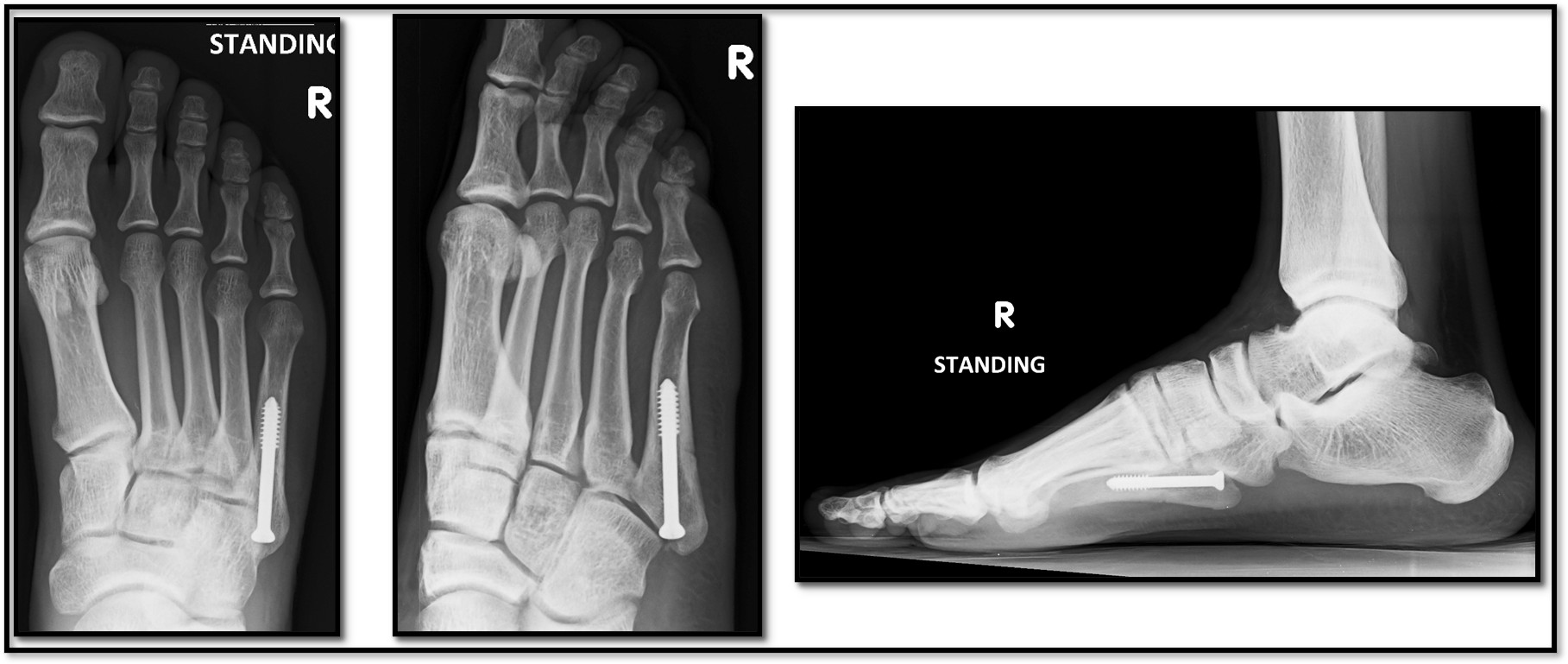 Zone 2 Jones fracture post-op 3 months