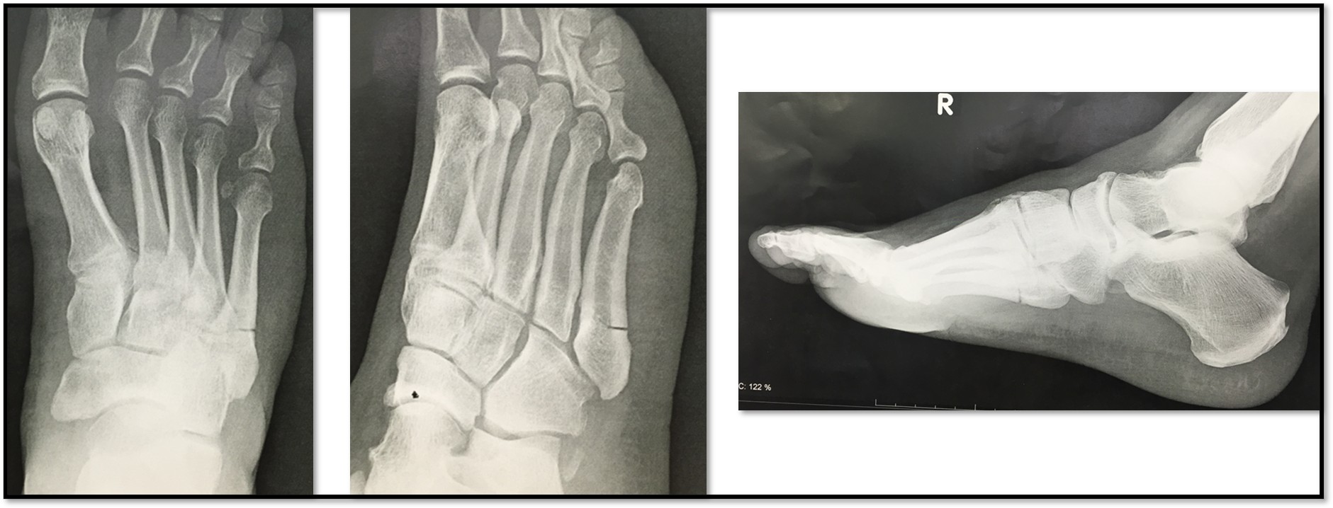 Zone 2 Jones fracture x-rays