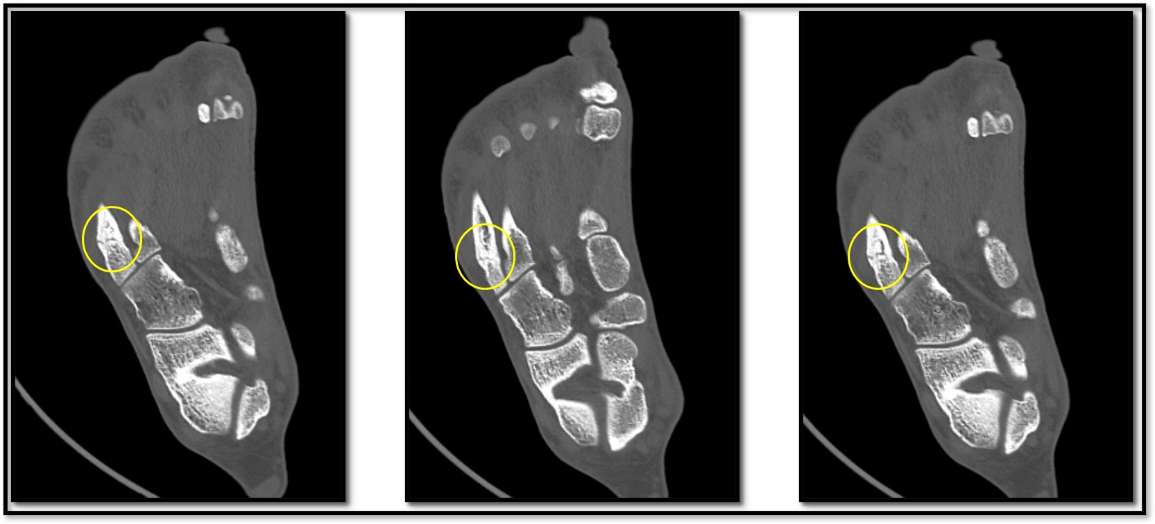 Zone 3 Stress fracture CT