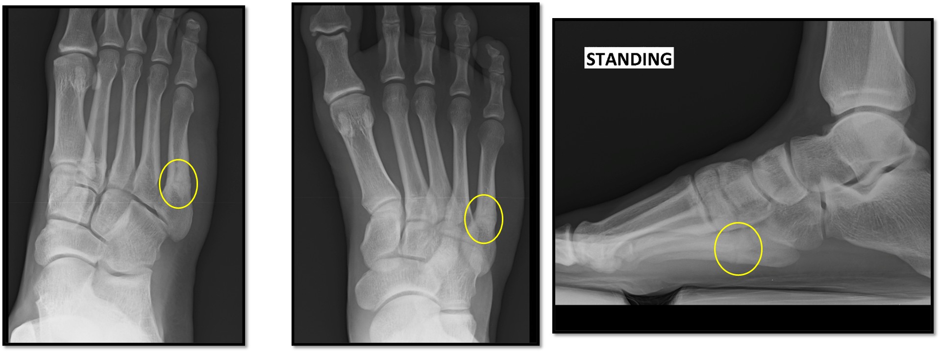 Zone 3 Stress fracture