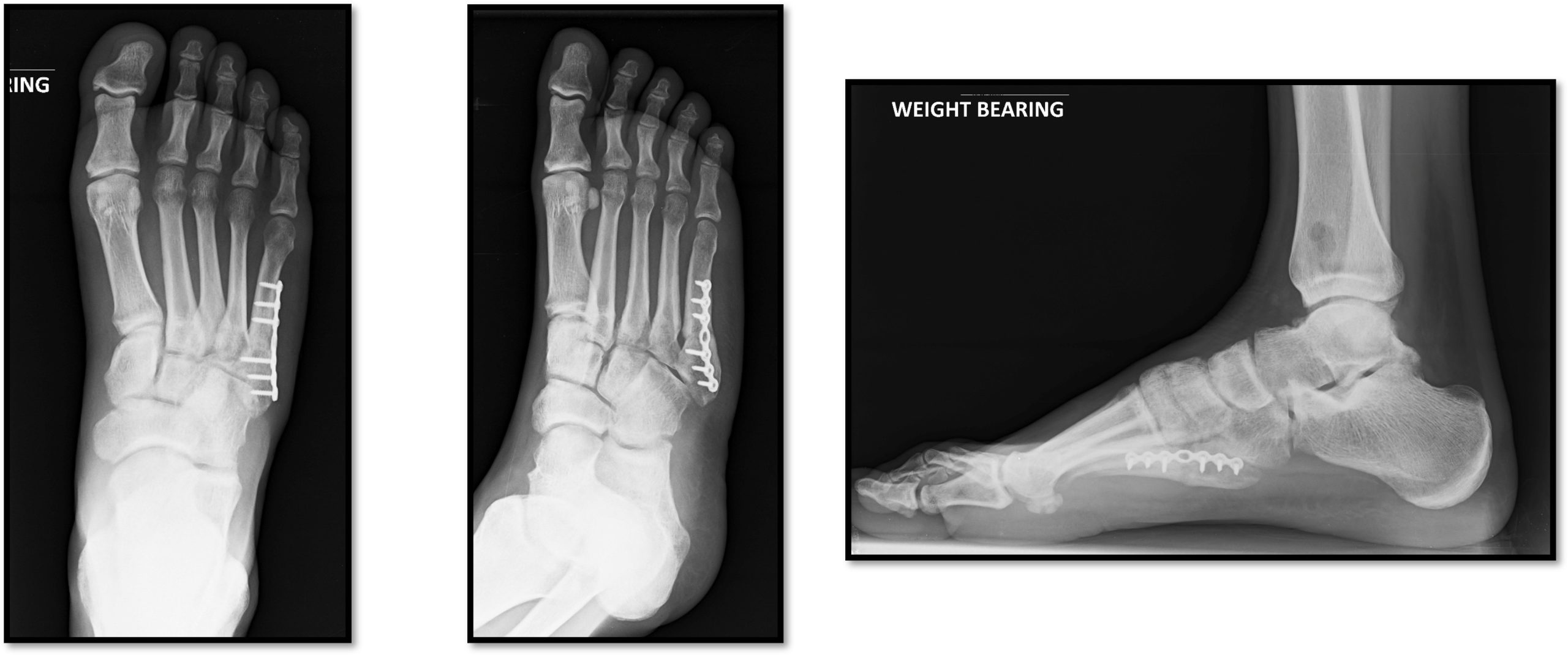 Zone 3 Stress fracture post-op 3 months